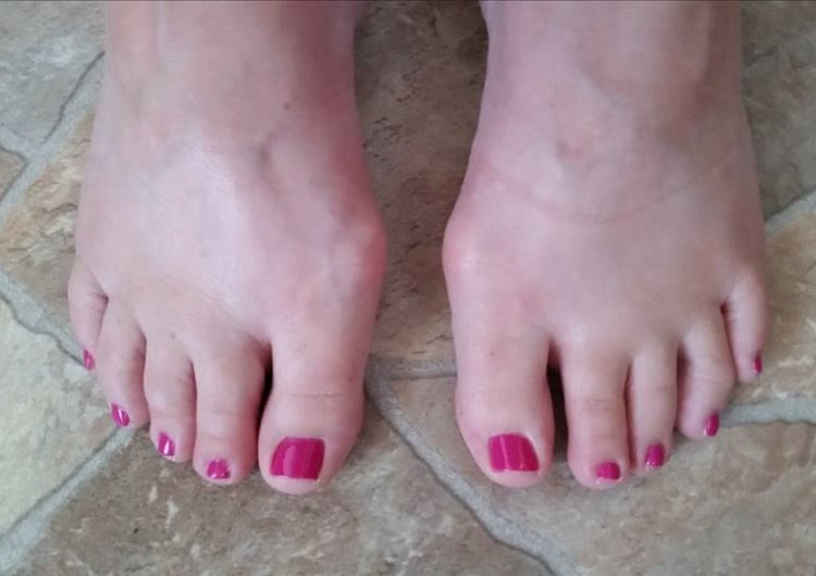YOUR BUNION STOPPING YOU FROM RUNNING?