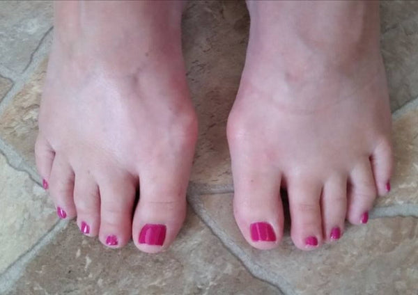 YOUR BUNION STOPPING YOU FROM RUNNING?